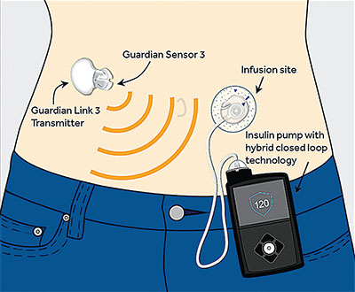 A New Way to Manage Type 1 Diabetes